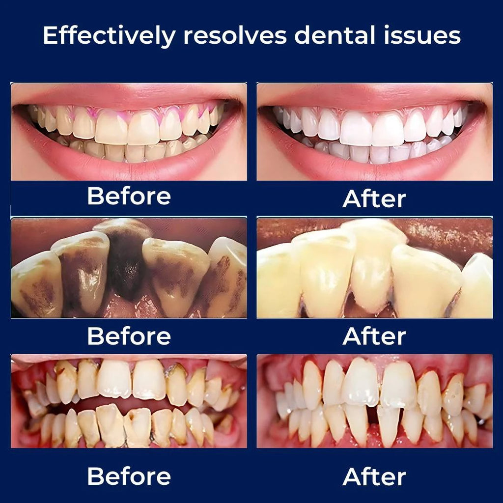 PlaqueFree Plaque Remover for teeth | Ultrasonic Teeth Cleaner - Tartar Remover from Home - Deep Teeth Cleaning and Polish Bowlift by Bowlift