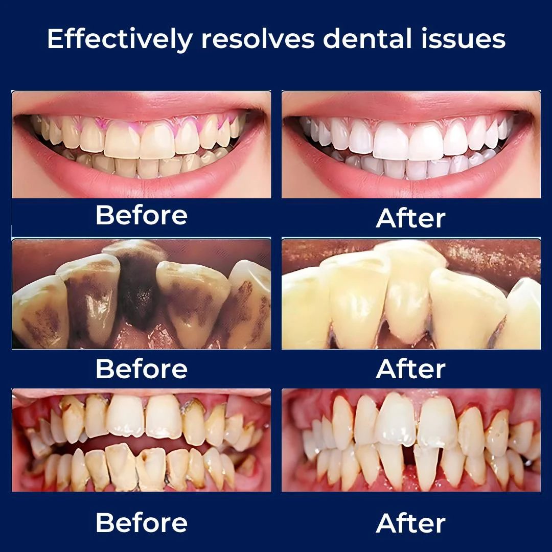 PlaqueFree Plaque Remover for teeth | Ultrasonic Teeth Cleaner - Tartar Remover from Home - Deep Teeth Cleaning and Polish Bowlift by Bowlift