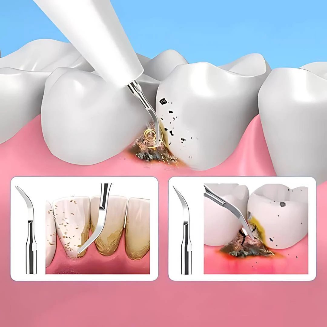 PlaqueFree Plaque Remover for teeth | Ultrasonic Teeth Cleaner - Tartar Remover from Home - Deep Teeth Cleaning and Polish Bowlift by Bowlift