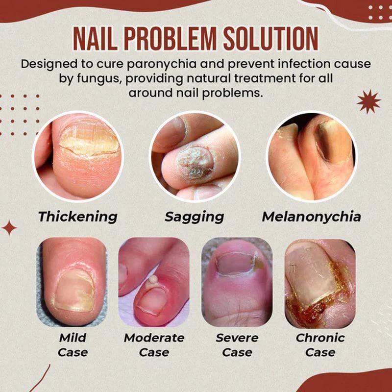 Nail Anti-Fungus Socks by BowLift