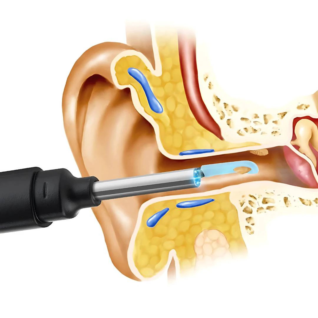 EarScope Pro - Smart Visual Earwax Removal Tool | LED Camera and Soft Tips - Safe and Precise Ear Cleaning Bowlift by Bowlift