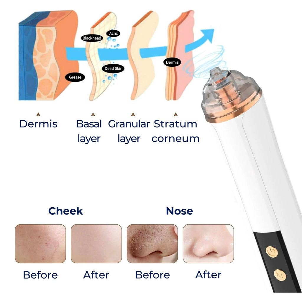GlowEase | Microdermabrasion Kit – Blackhead Remover – USB Rechargeable – At-Home Skincare Solution Bowlift by Bowlift