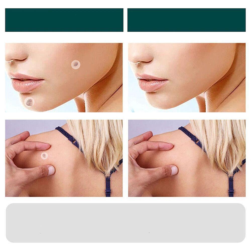 SkinClear - Patch for the removal of spots and warts Bowlift by Bowlift
