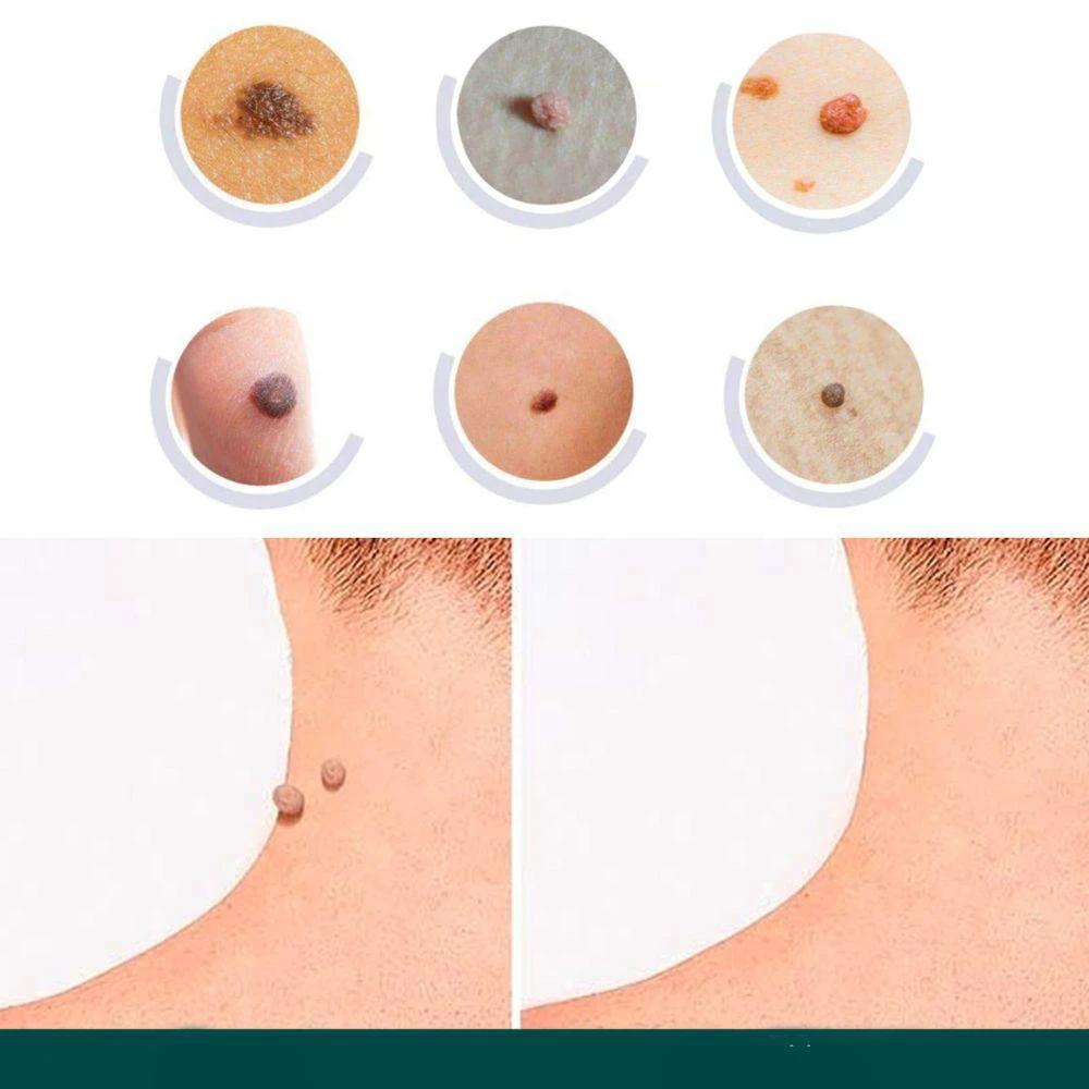 SkinClear - Plaster for the removal of spots and warts by BowLift