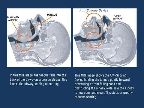 Apnea Tongue Stabilizing Device by BowLift